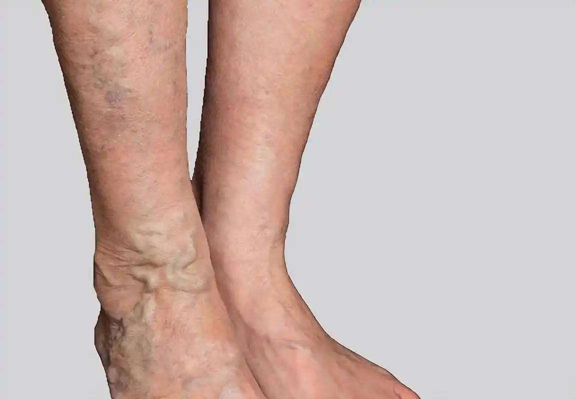 必发彩票app下载链接在哪-女子因肺栓塞不幸走了！医生：天冷宁愿躺一天，也别干这5事！