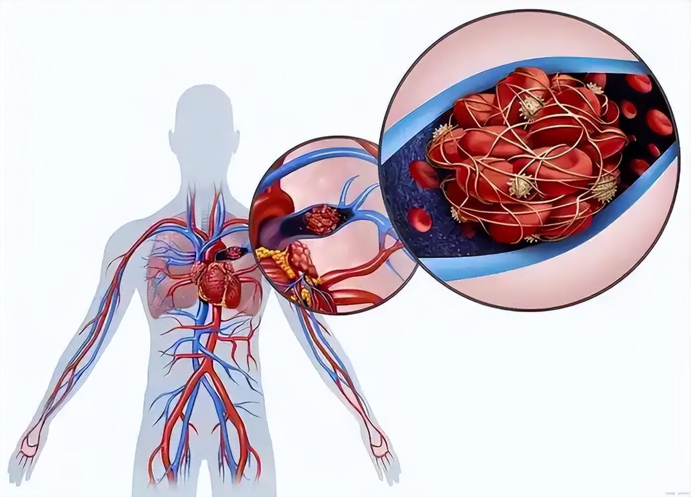 必发彩票app下载链接在哪-女子因肺栓塞不幸走了！医生：天冷宁愿躺一天，也别干这5事！